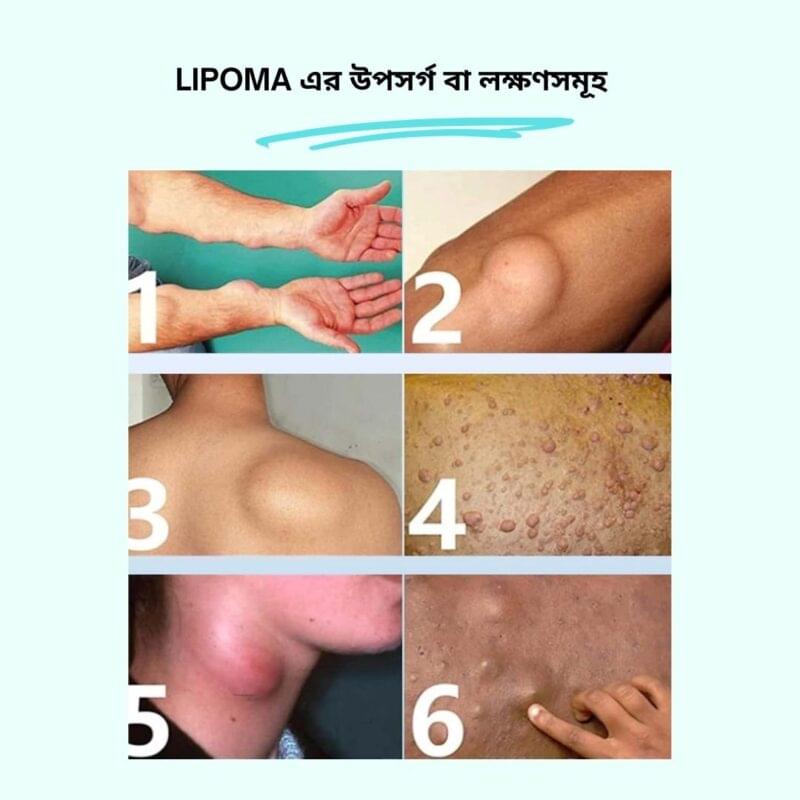 Lipoma এর উপসর্গ বা লক্ষণসমূহ