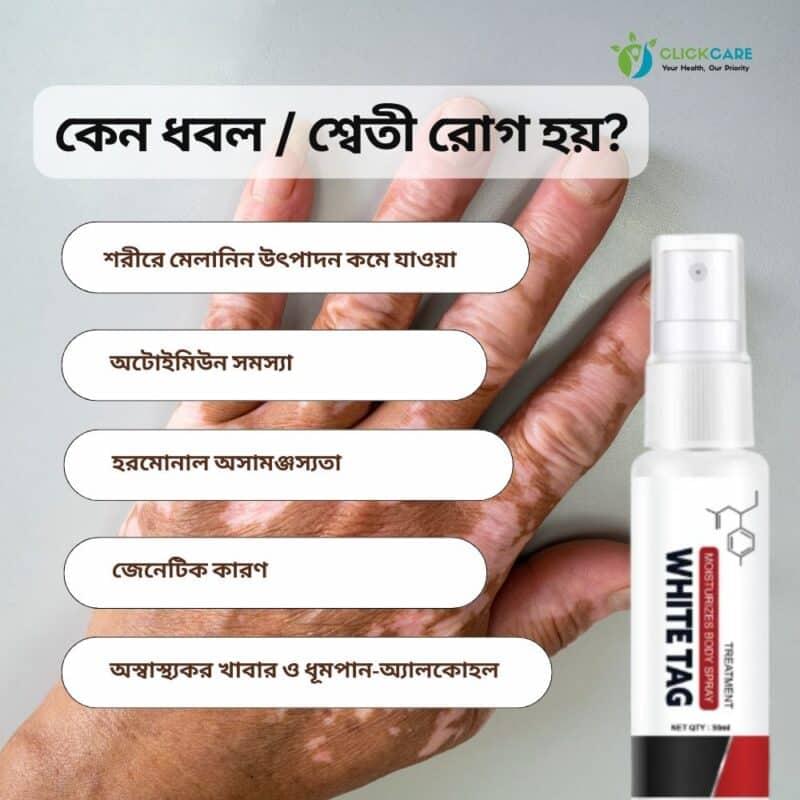 কেন ধবল রোগ হয় (2)